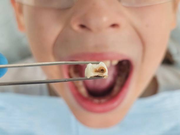 Best Emergency Dentist for Lost Fillings or Crowns in Ruston, WA