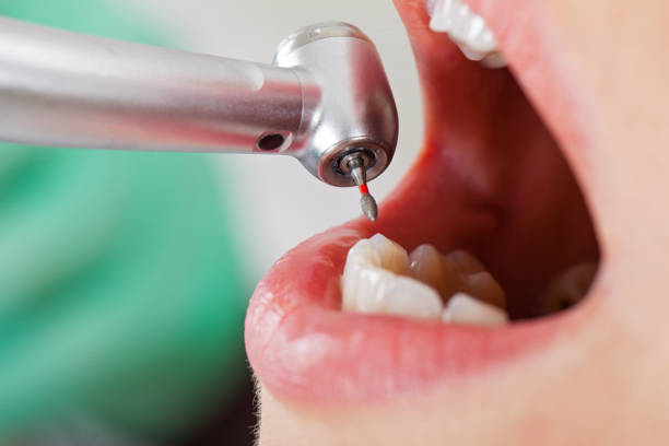 Best Emergency Root Canal Treatment in Ruston, WA